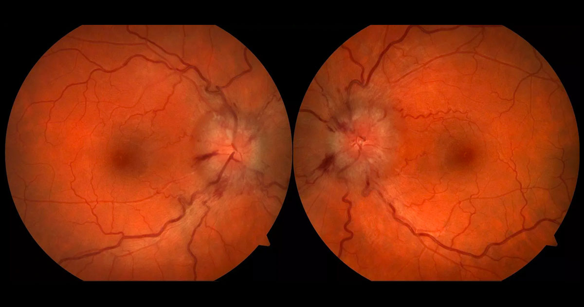 Bilateral optic disc swelling with blurring of the disc margins and retinal nerve fibre layer haemorrhages.