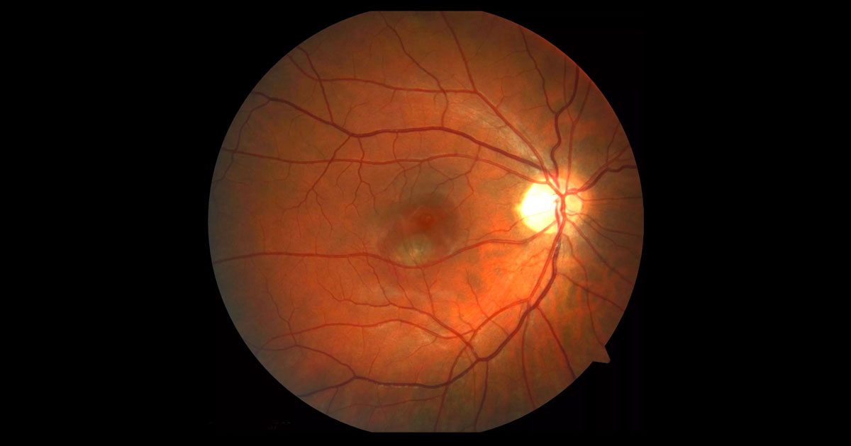 There is a serous retinal detachment of right macula. A grey/green lesion is present deep to this.
