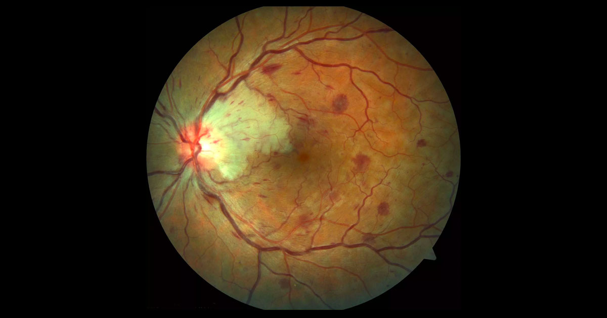 Colour fundus photography of the left eye shows four quadrant intraretinal haemorrhages and engorgement of the retinal veins. There is a patch of white retina adjacent to the optic nerve.
