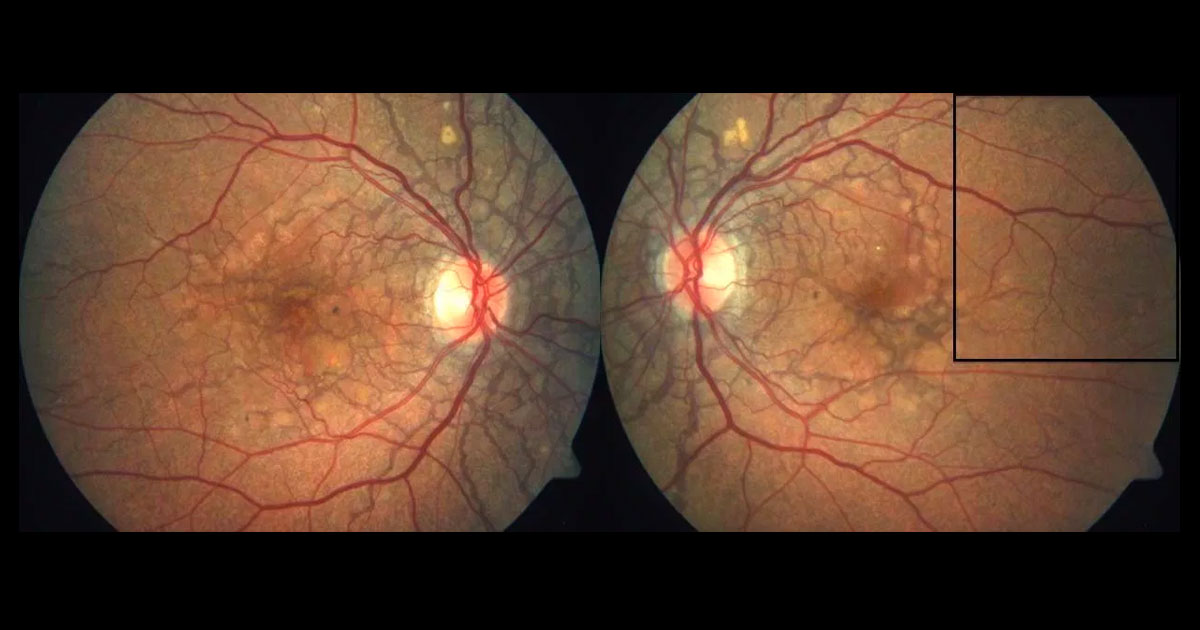 Fundus photographs reveal bilateral subretinal dark grey concentric and radial lines particularly around the optic nerve heads and maculae.