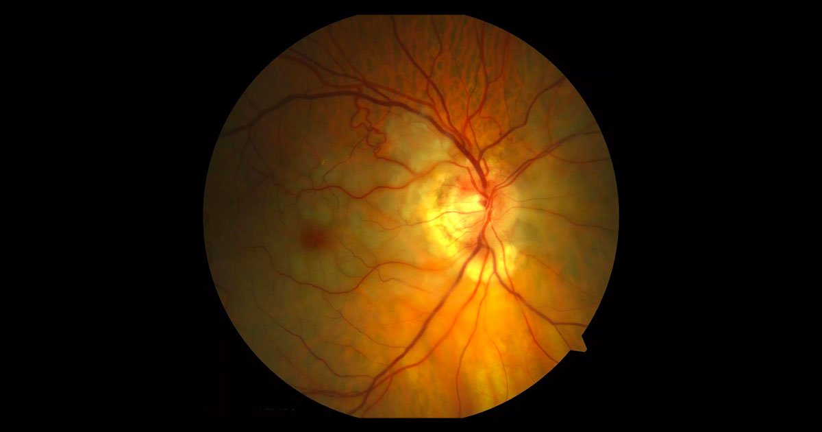 Colour fundus photograph shows pallor of the right retina with a cherry red spot at the macula.