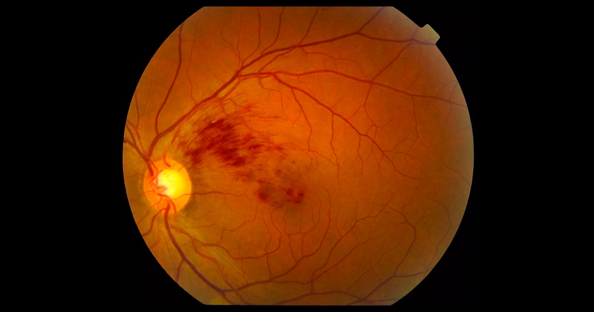 Colour fundus photograph of the left eye reveals intraretinal flame-shaped haemorrhages in the left superonasal macula.
