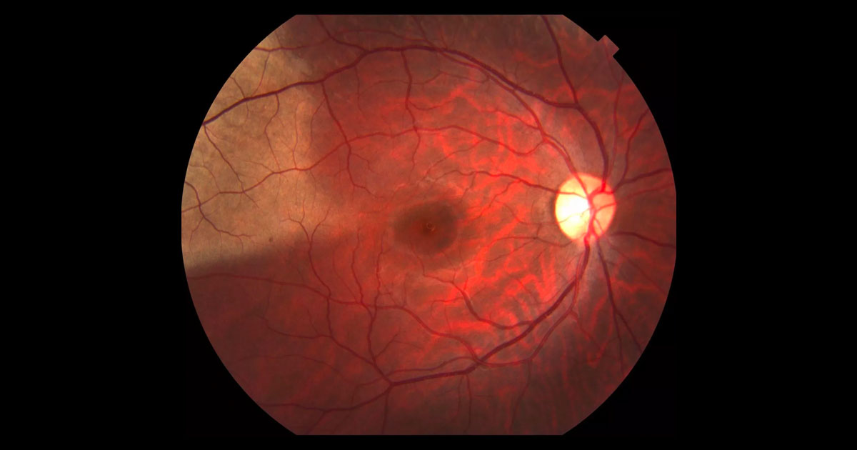 Colour fundus photograph of the right eye reveals a whitish discolouration of the retina temporal to the fovea.