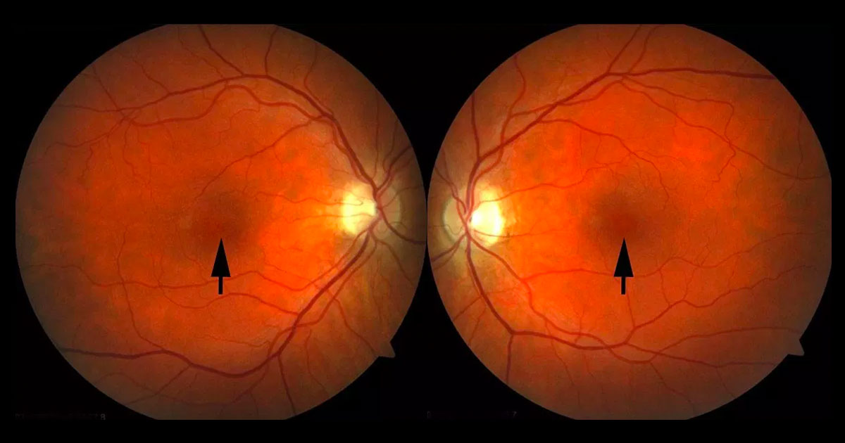 Colour fundus photographs showing subtle yellow dots at both foveae, larger on the left.