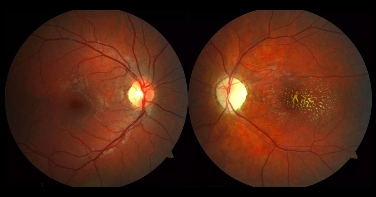 Colour fundus photographs showing yellow deposits at the left macula and a pale left optic disc.
