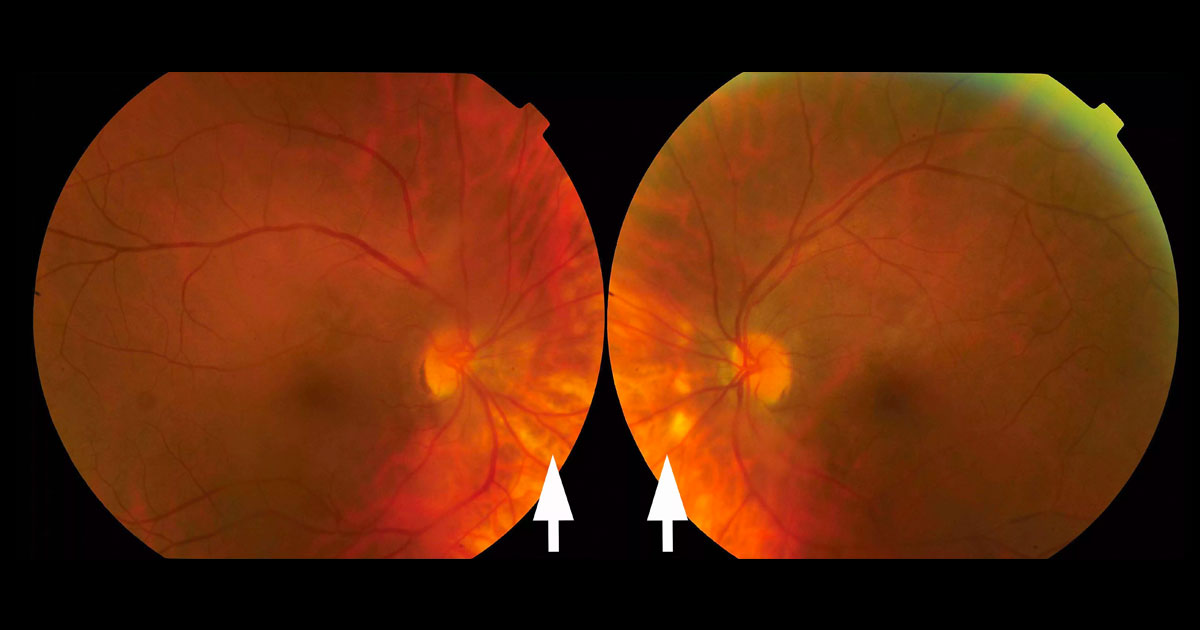 Colour fundus photographs reveal multiple, deep, yellow-white lesions nasal to the optic discs.