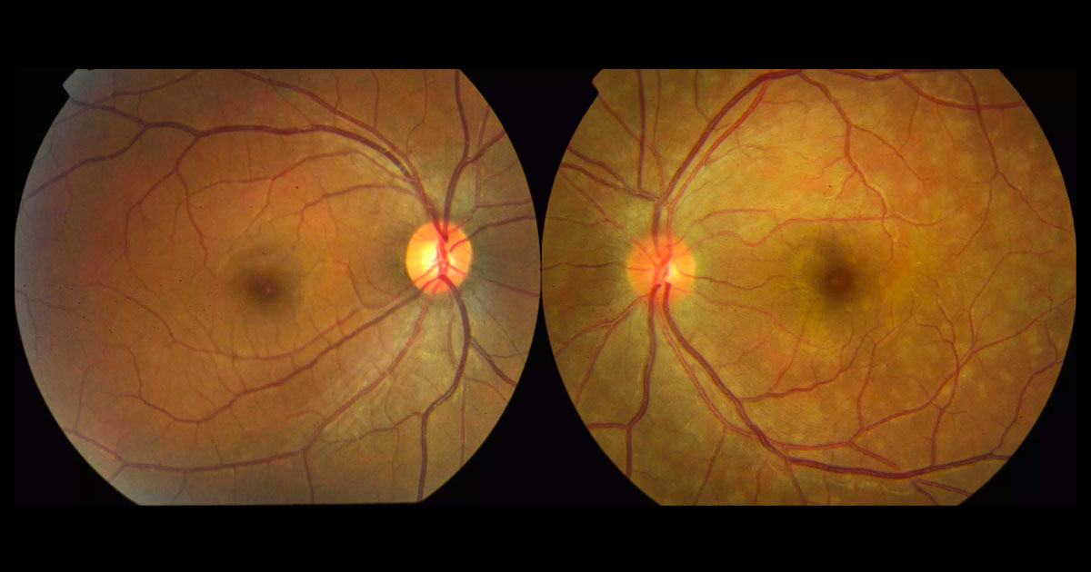 Colour fundus photograph of the left eye shows multiple deep retinal white dots at the left macula with a slightly abnormal foveal reflex. The right fundus is normal.