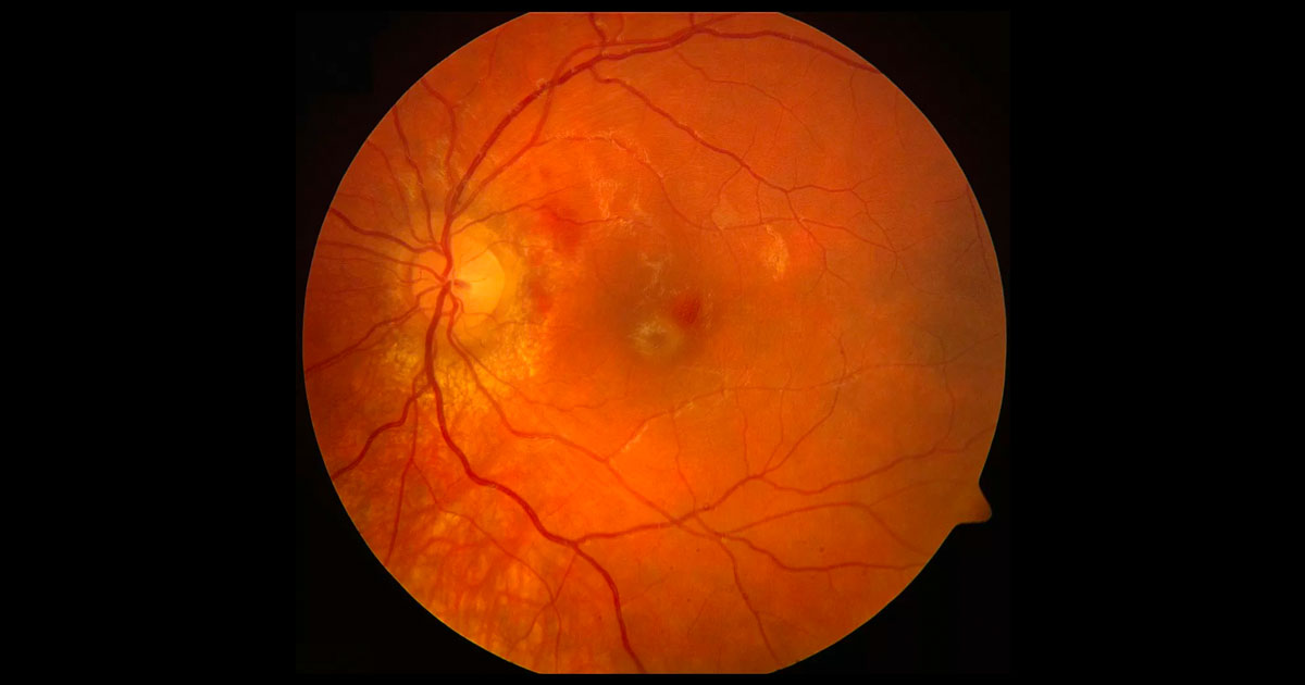 Right fundus photograph showing a haemorrhage at the right macula.