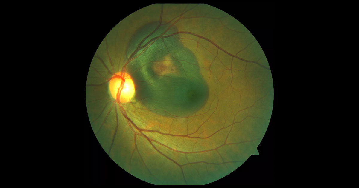 Colour fundus photography of the left eye demonstrates a left submacular haemorrhage.