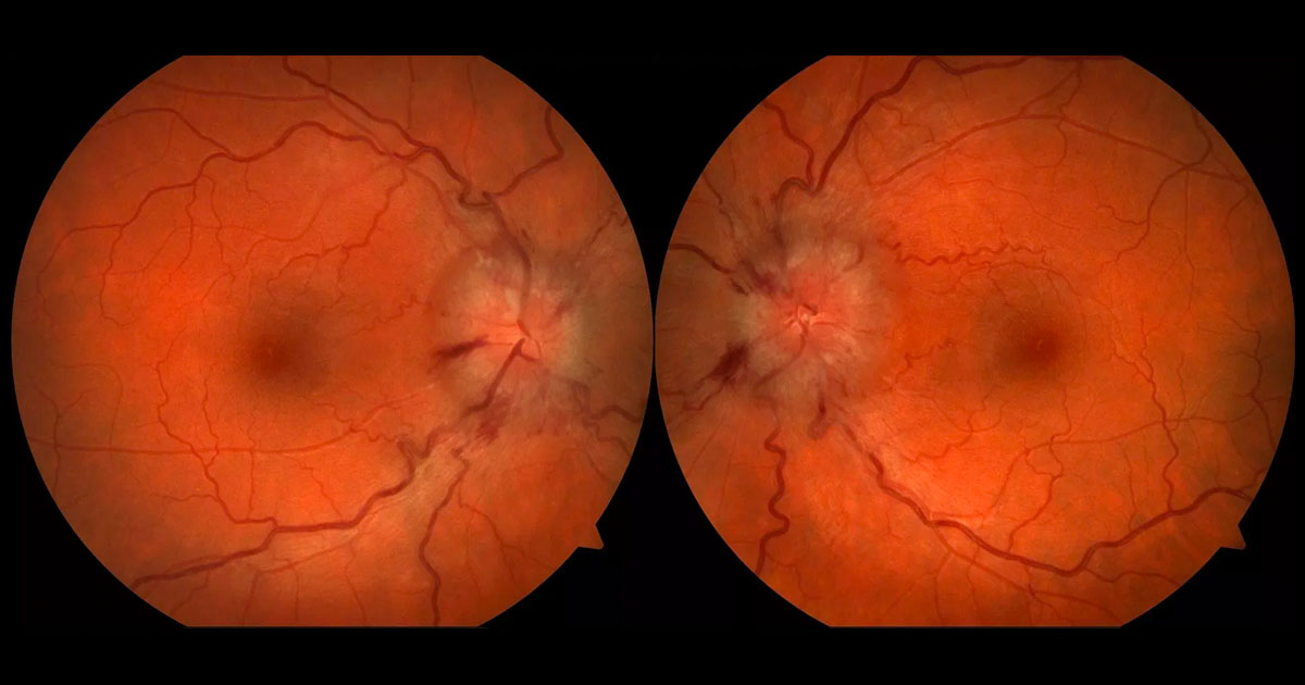 Bilateral optic disc swelling with blurring of the disc margins and retinal nerve fibre layer haemorrhages.