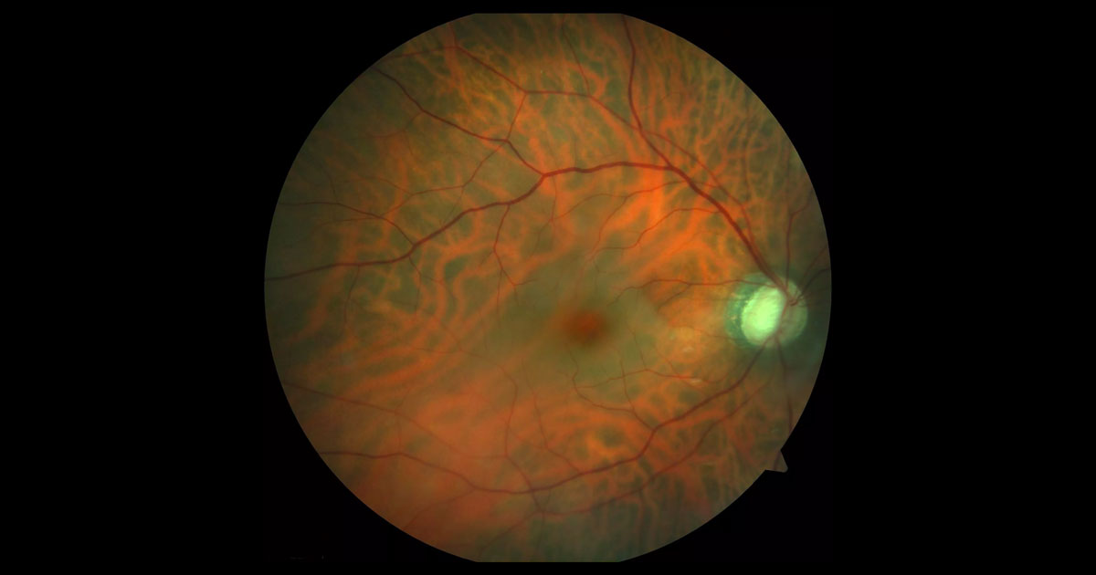 Colour photograph of the right fundus at presentation demonstrates retinal pallor with a cherry red spot at the macula. The cup disc ratio is enlarged.