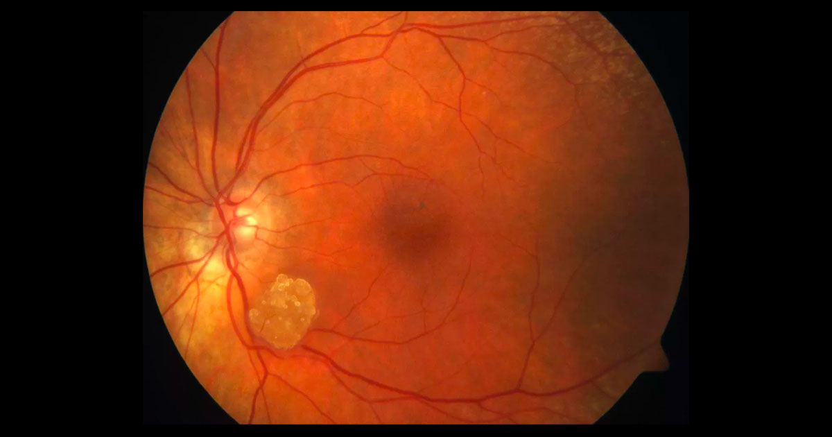A yellowish-white preretinal lesion is present just inferotemporal to the left optic disc. It is mulberry shaped and has fine surface vessels.