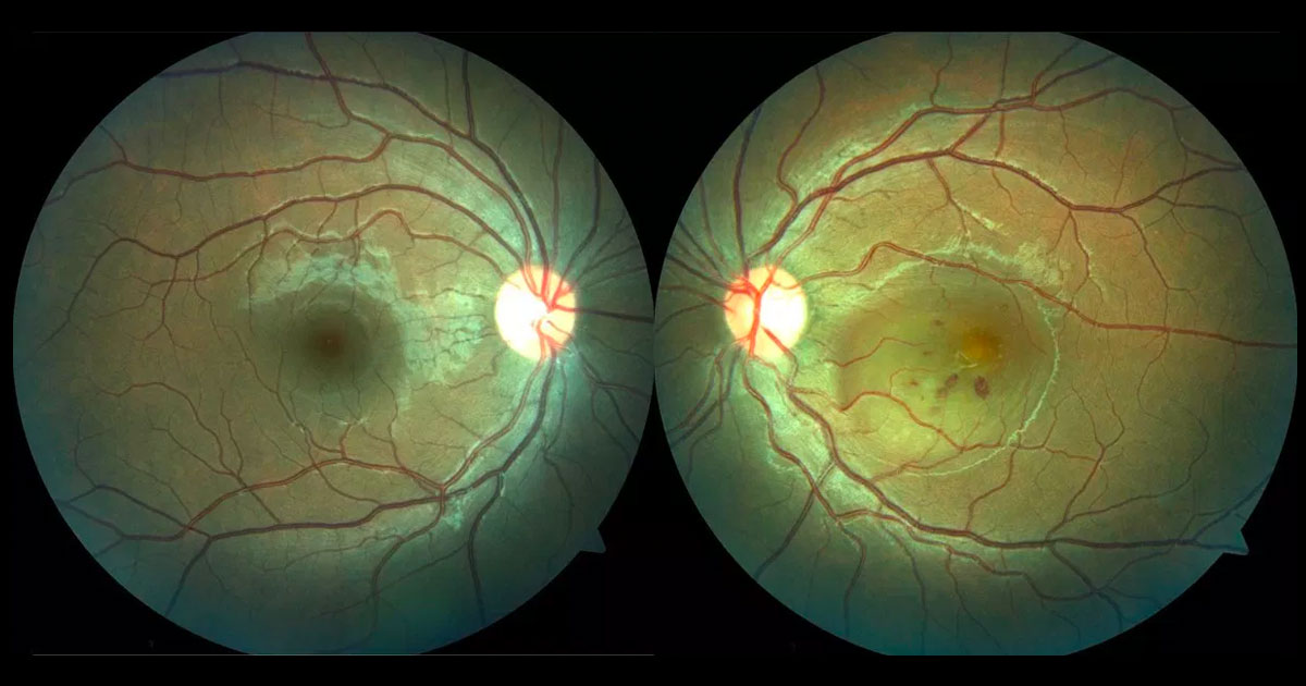 Colour photograph demonstrating a well demarcated circular area of left macular elevation together with retinal haemorrhages.