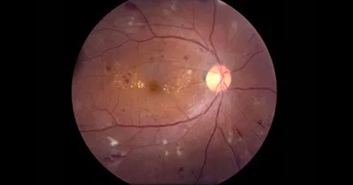 Retinal and Macular Specialists are participating in the Aussiedex trial assessing the efficacy and side effects of intravitreal Ozurdex for the treatment of diabetic macular oedema in pseudophakic patients. 