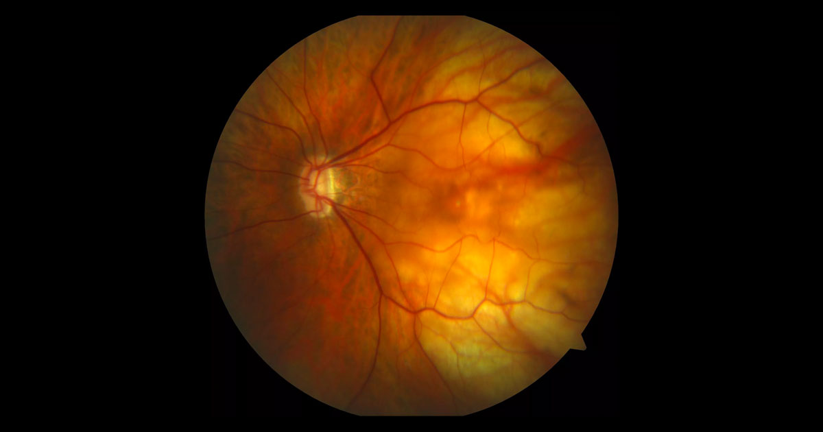 Colour fundus photograph of the left macula. There are signs of myopia including tilting of the optic disc, tessellation and pallor in the temporal posterior pole.