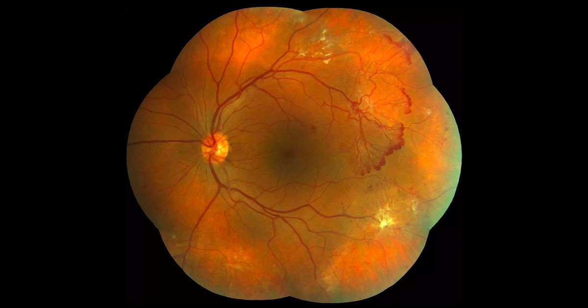 Colour fundus photograph of the left eye demonstrates florid neovascularization temporal to the macula. There are white areas representing fibrosis. No macula oedema was evident clinically.