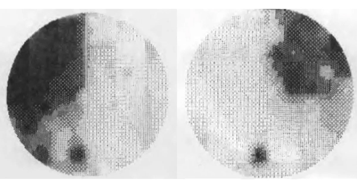 Visual field testing shows temporal scotomas in both eyes.