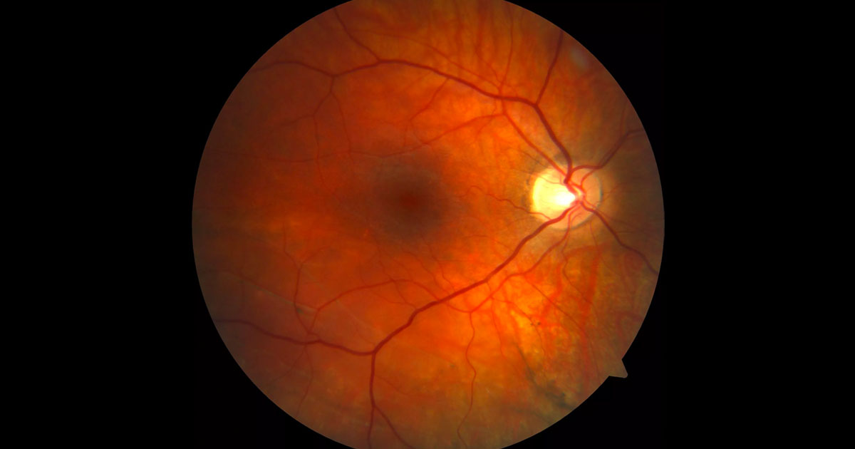 Colour fundus photography of the right macula. Prominent choroidal vessels suggests myopia. There is subtle subretinal elevation inferior to the fovea and horizontal white pigmented lines inferotemporally.
