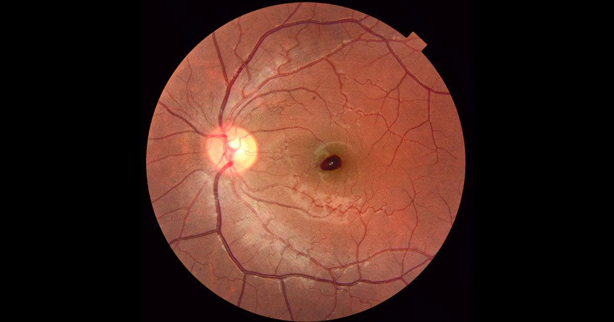 Colour fundus photograph of the left eye shows a well-circumscribed dark patch at the fovea.