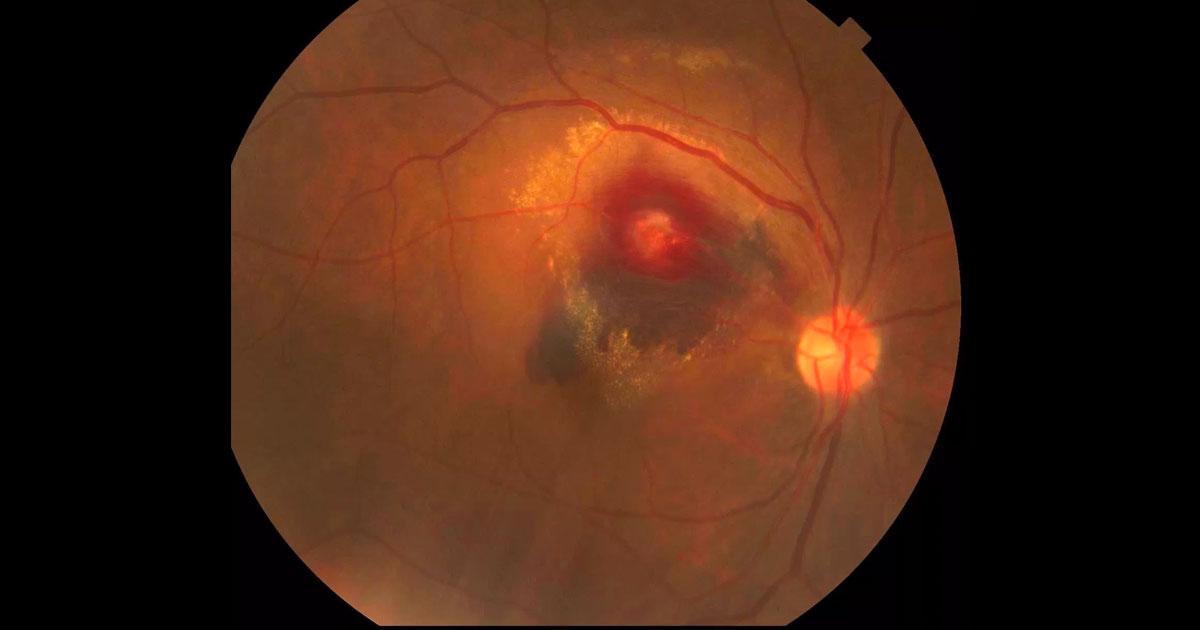 Colour photograph of the right eye at presentation demonstrating a multilayered haemorrhage and hard exudate involving the macula.