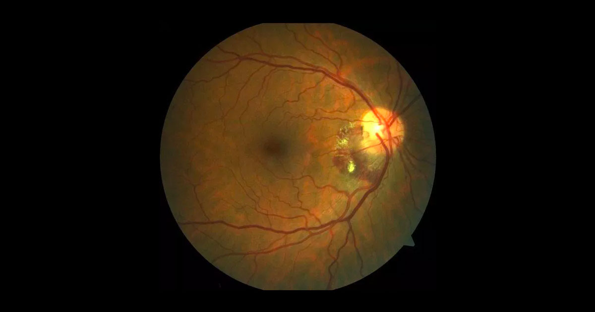 Colour fundus photography of the right macula.