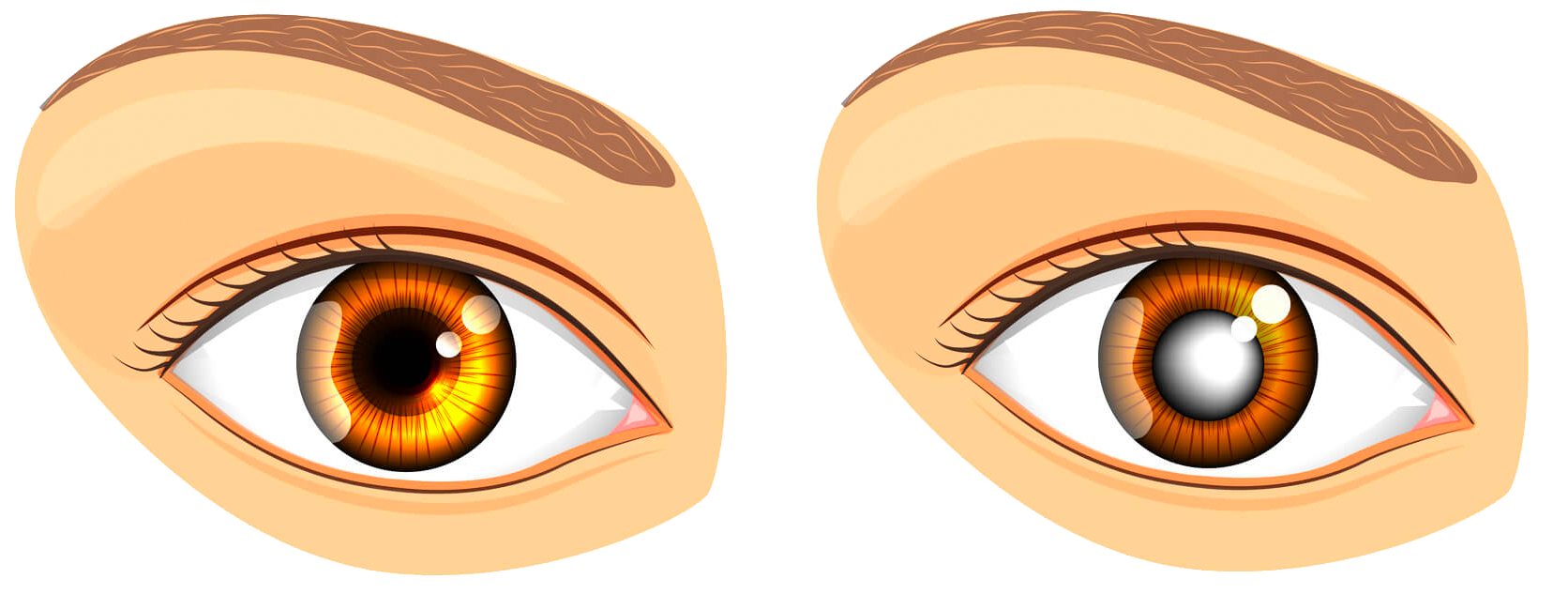 Diagram of a healthy eye vs an eye with cataract