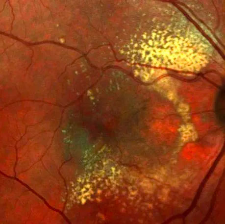 Age-related macular degeneration