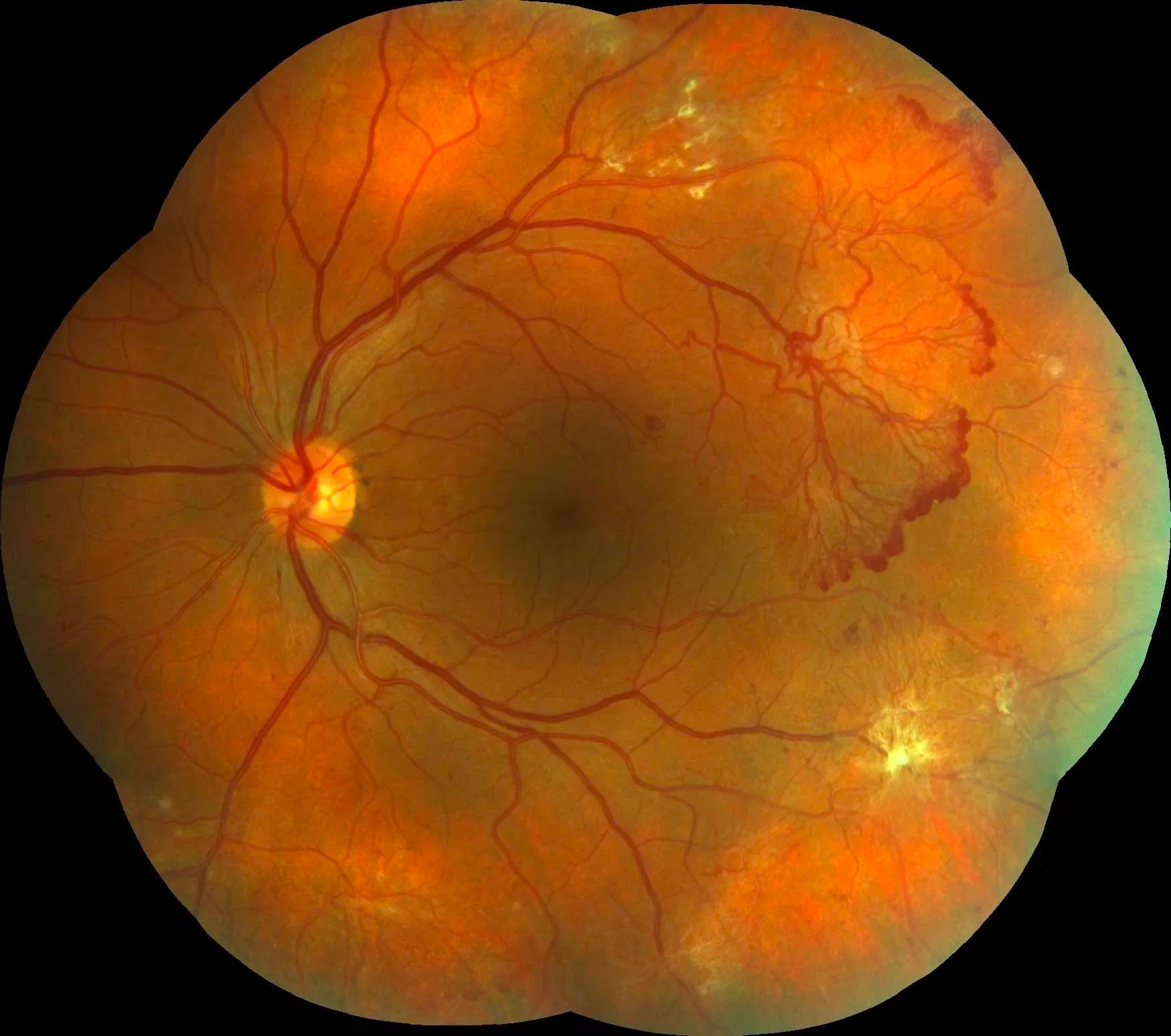 Diabetic retinopathy