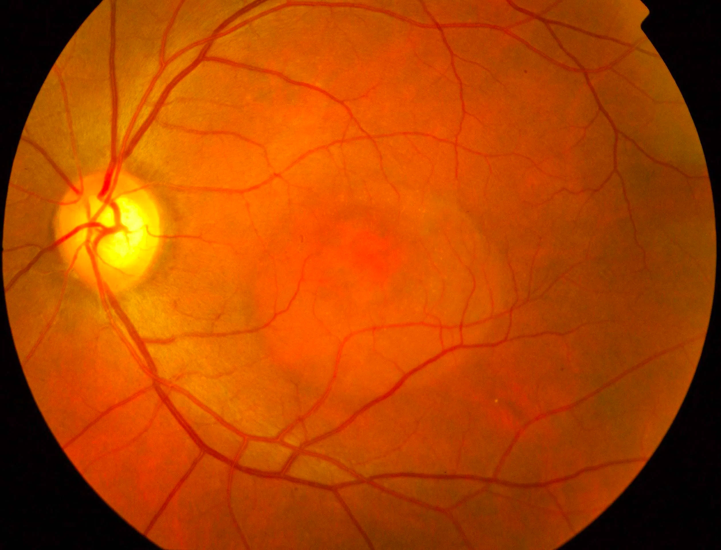 Central serous chorioretinopathy