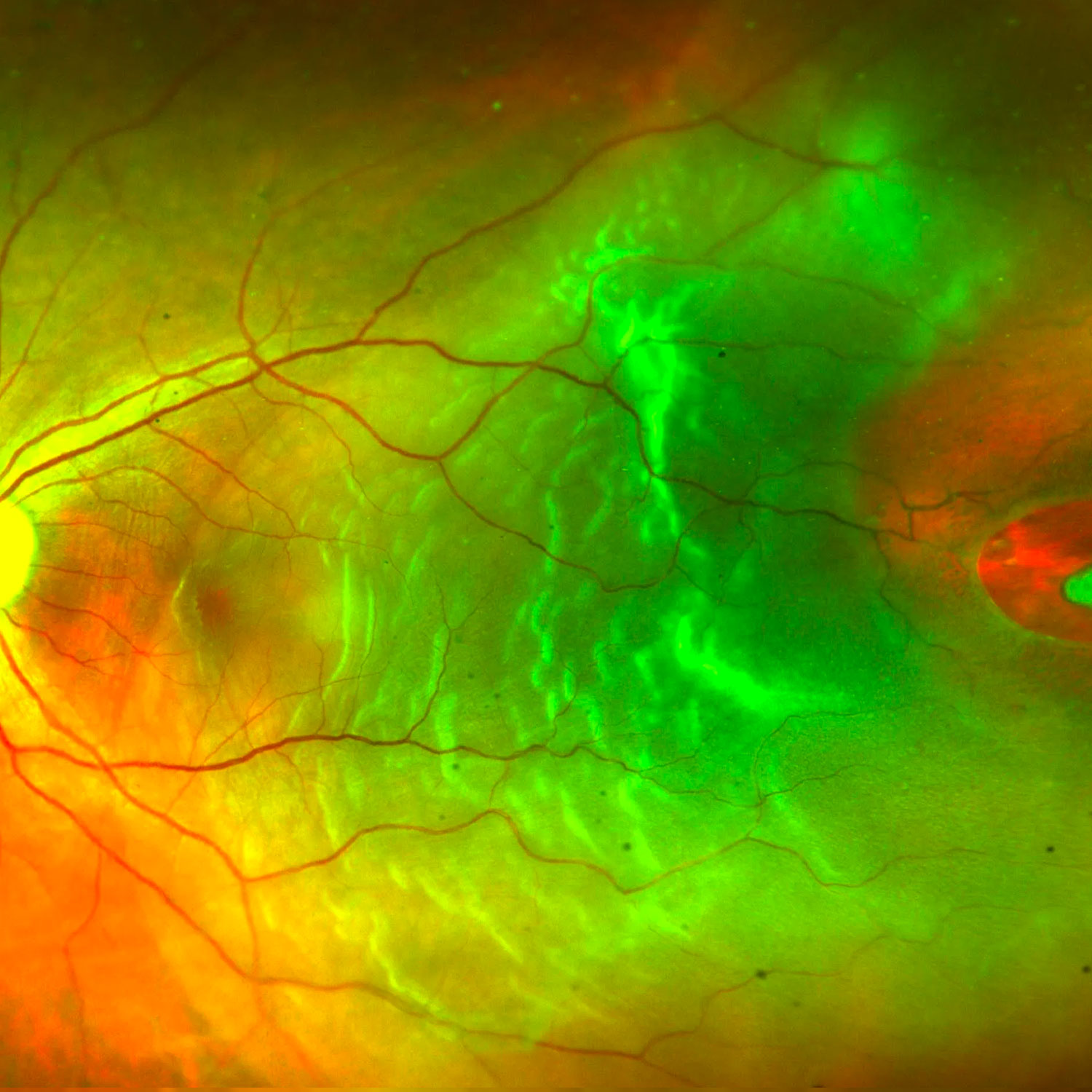 Retinal tear and detachment