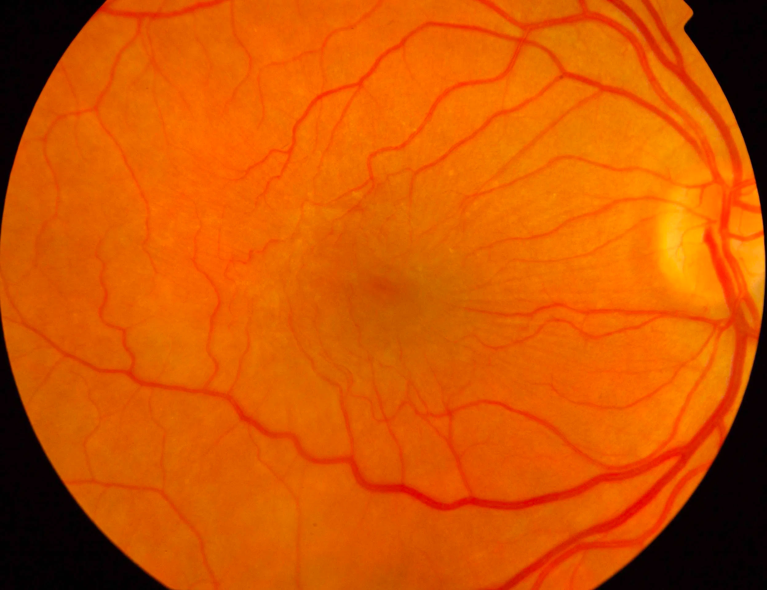 Epiretinal membrane