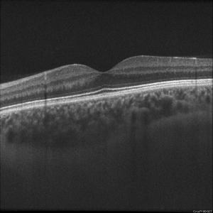 Spectral-Domain Optical Coherence Tomography (SD-OCT)