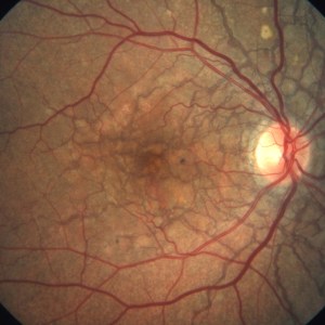 Fundus Photography