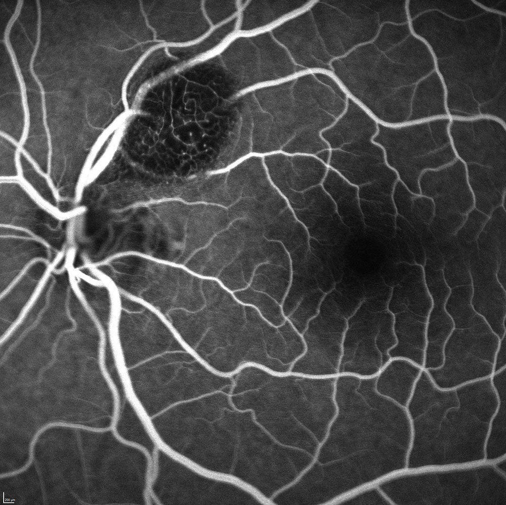 Fluorescein Angiography