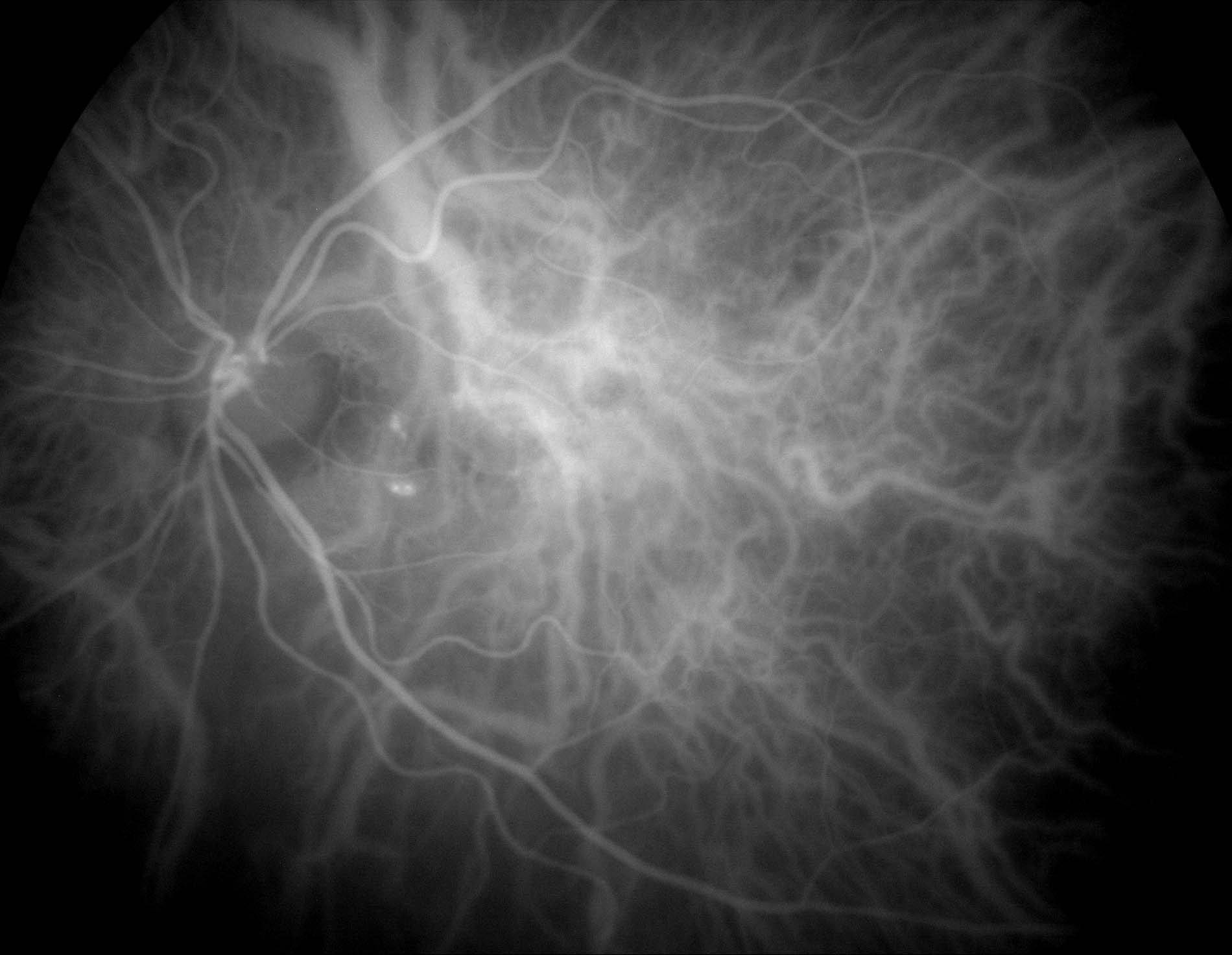 Indocyanine Green Angiography