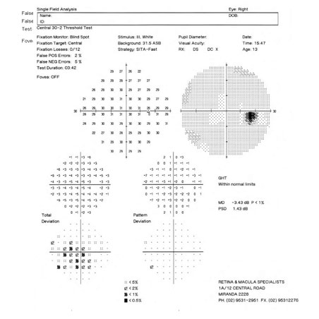 Humphrey Visual Field